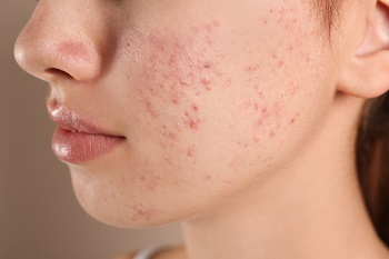 Acne