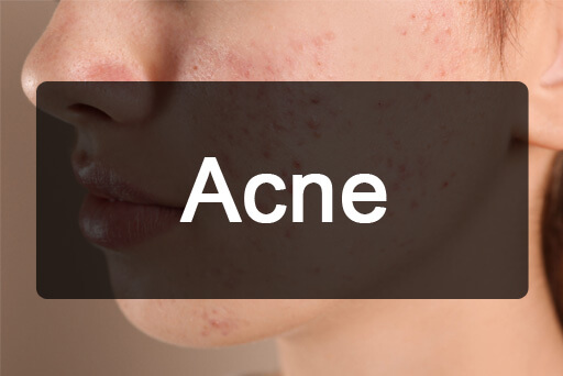 Acne