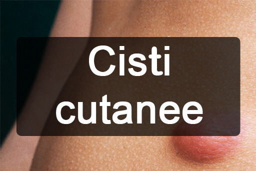 Cisti - rimozione