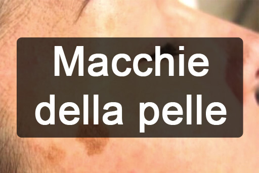 Macchie della pelle