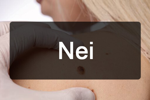 Nei - rimozione