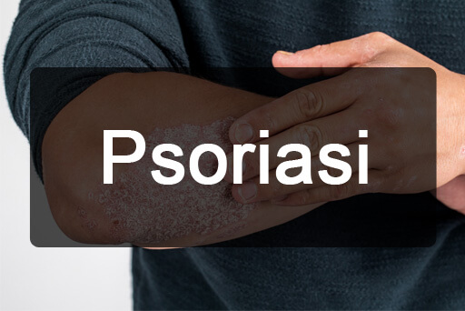Psoriasi