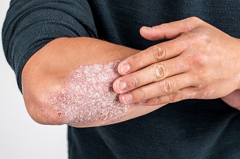 Psoriasi